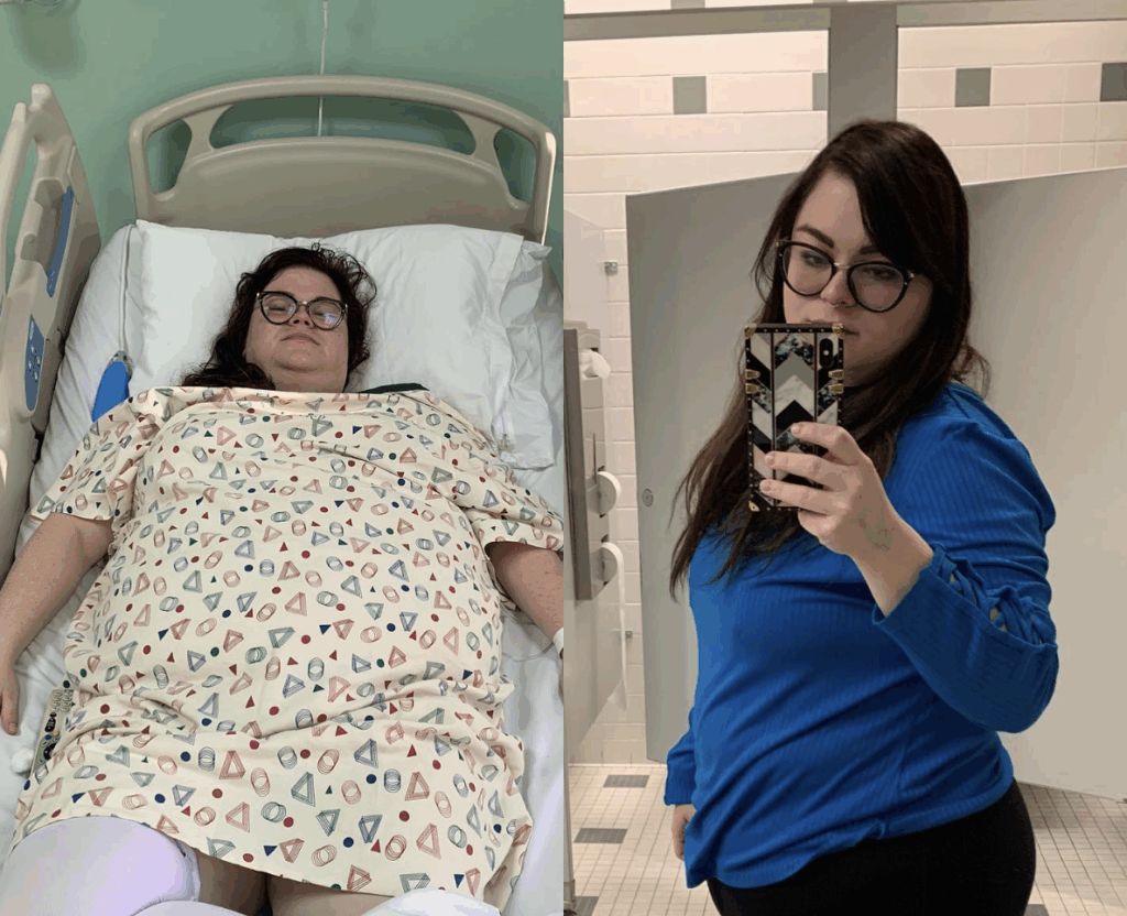 Before and After Gastric Sleeve Surgery in Tijuana Mexico Patient Erica